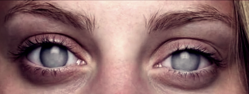 blind