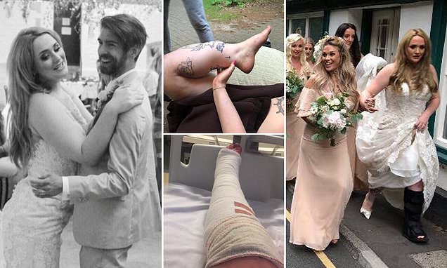 Bride-to-be broke her leg in four places on her hen do