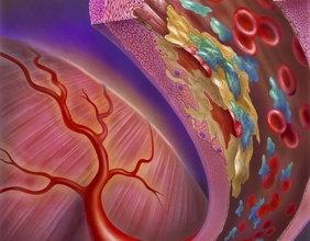 Grafik einer verstopften Arterie