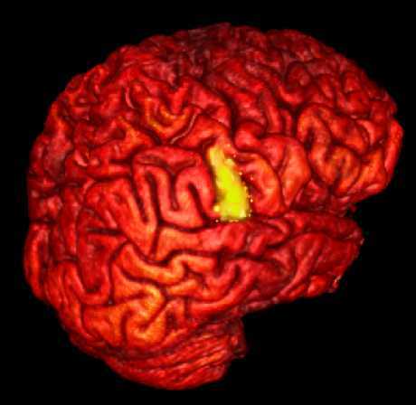 Neuroimaging